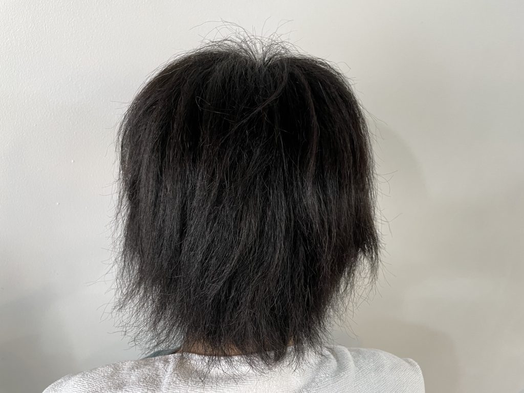 男性|酸熱トリートメント例2|before